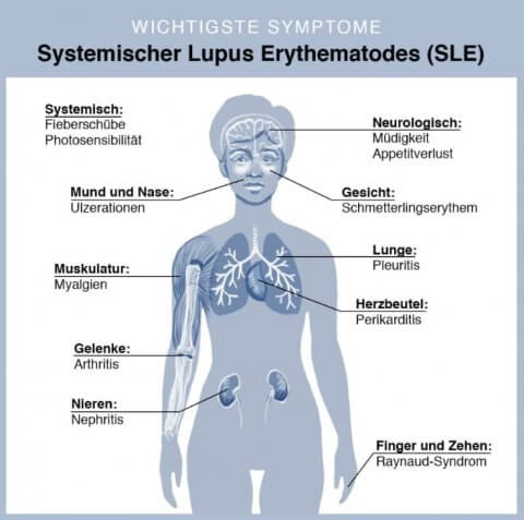 Lupus erythematodes: Symptome, Therapie | Praxis Breitenberger