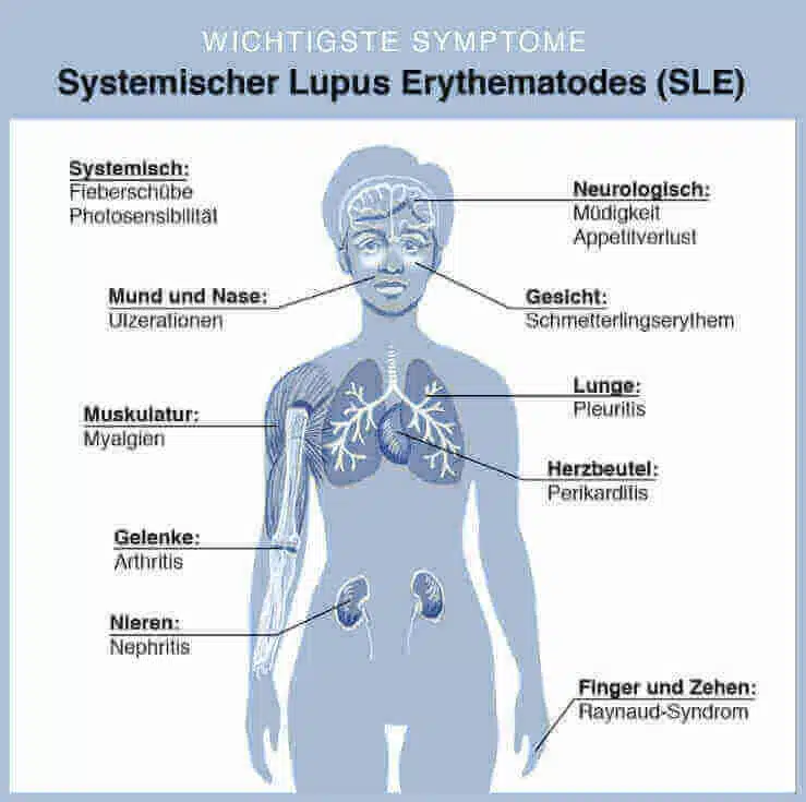 Systemischer Lupus erythematodes