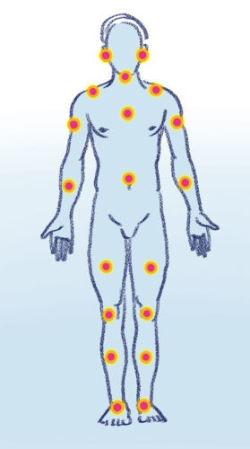 Fibromyalgie Test & Fibromyalgie erkennen | Breitenberger