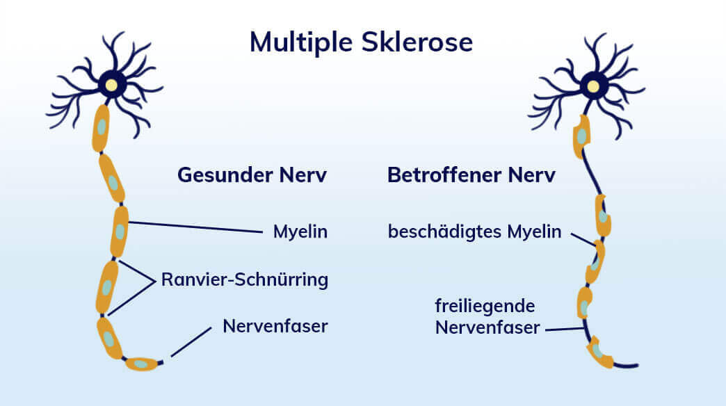 Multiple Sklerose (MS) Symptome, Verlauf, Therapie