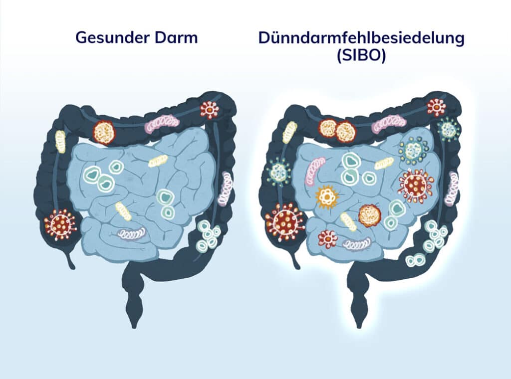 Zwei Skizzen eines menschlichen Darms nebeneinander. Einmal Überschrift "Gesunder Darm" mit wenig Bakterien im Dünndarm, daneben Überschrift "Dünndarmfehlbesiedelung SIBO" mit viel Bakterien in Dick- und Dünndarm.